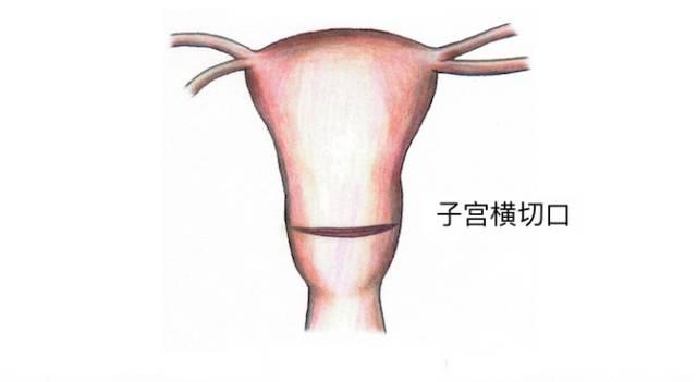 产后两个月侧切口疼痛，原因、处理与预防