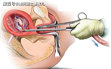 五个月堕胎对女性身体的伤害分析