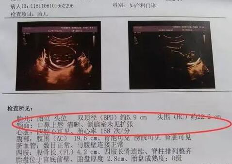 关于三个月B超鉴定胎儿性别是否会翻盘的探讨