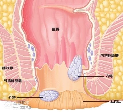 关于7个月宝宝肛门出现痔疮的探讨